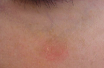 7 Tage nach der Lasertherapie