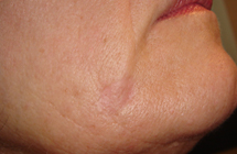 7 Tage nach der Lasertherapie