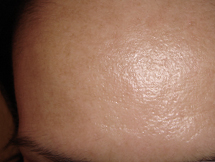 Nach zweimaligem chemischem Peeling