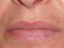 Nach dreimaligem chemischem Peeling