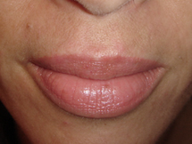 Nach zweimaligem chemischem Peeling