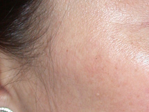 Nach zweimaligem chemischem Peeling