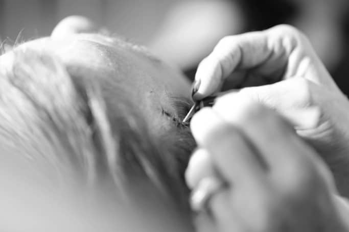 Hauttumoren Hauttumoren